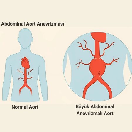 ABDOMİNAL AORT ANEVRİZMASI