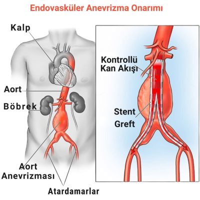 BT-Anjiyogram-2 BT-Anjiyogram-2