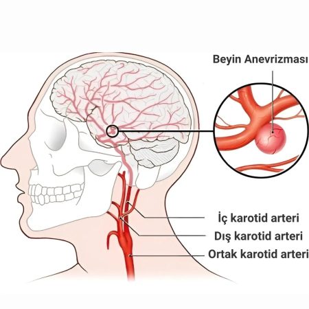 beyin damarı anevrizması